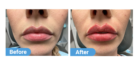 lip-filler-8