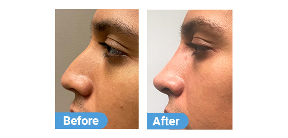 non-surgical-rhinoplasty-4